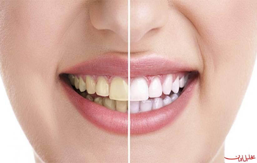  تحلیل ایران -روش نوین &quot;خمیردندان گیاهی&quot; برای سفیدی دندان‌ها 