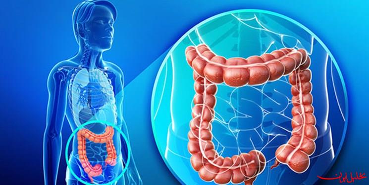 تحلیل ایران -زنگ خطر افزایش سرطان روده بزرگ در ایران