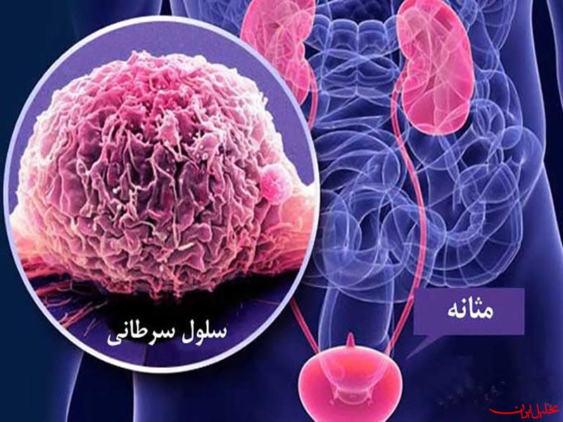  تحلیل ایران -مهم‌ترین عوامل ایجاد سرطان مثانه