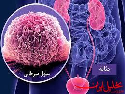  تحلیل ایران -مهم‌ترین عوامل ایجاد سرطان مثانه