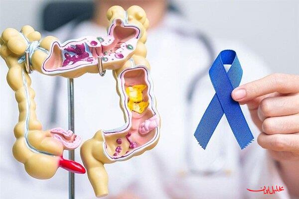  تحلیل ایران -تشخیص زودهنگام سرطان روده بزرگ برای زنان بسیار مهم است