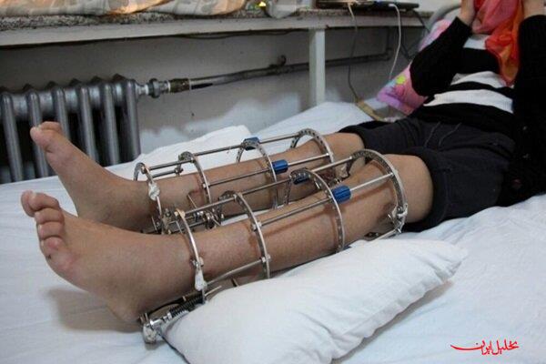  تحلیل ایران -جراحی افزایش قد؛ معجزه یا شکنجه مدرن؟