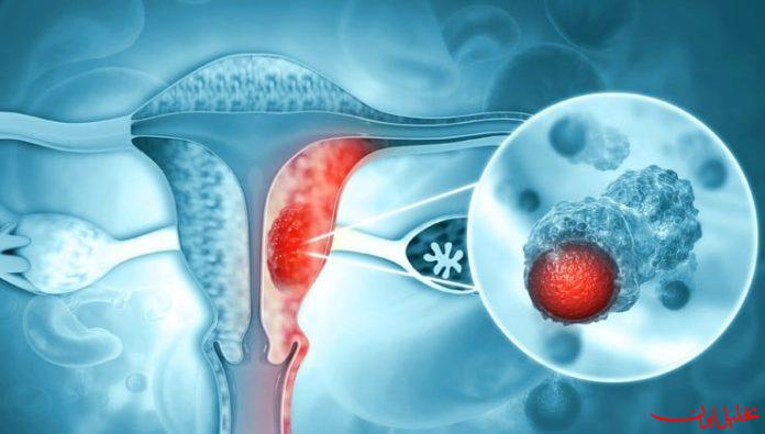  تحلیل ایران -ابتلا به سرطان دهانه رحم از نوجوانی آغاز می‌شود